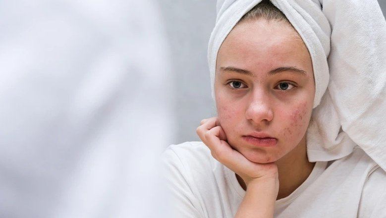 Врач раскрыла, работает ли салициловая кислота против прыщей